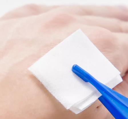 Alcohol prep pad used for skin disinfection before injection